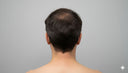 Rear view of a man showing thinning hair and crown hair loss on a neutral background.
